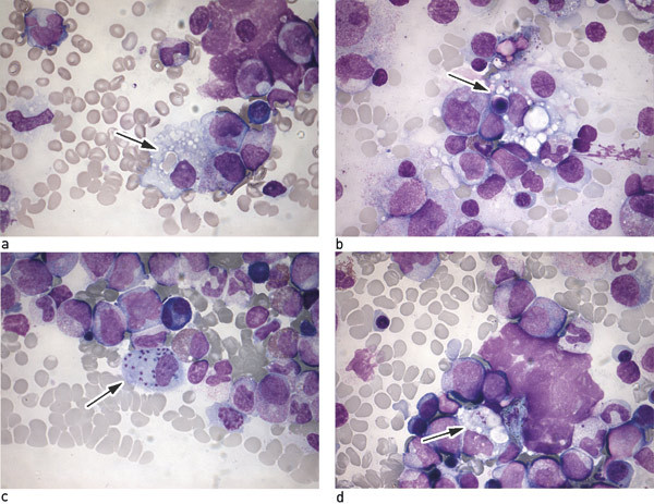 Figure 1  a) Bone marrow smear with macrophages with inclusions of erythrocytes (arrow). b) Bone marrow smear with…