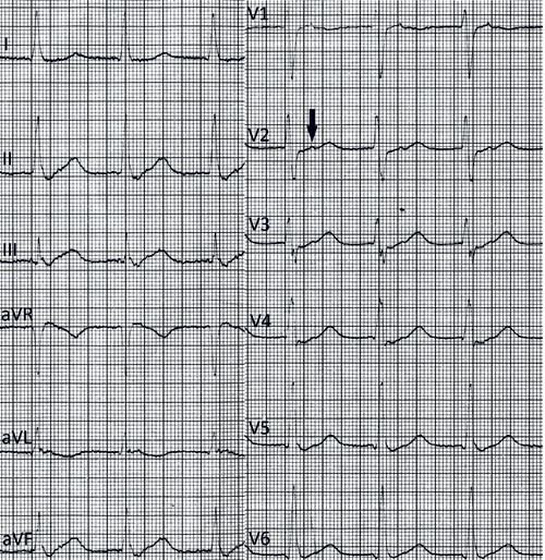 Figure 1:  ECG taken approximately one year prior to the admission in question. Supraventricular tachycardia with a…