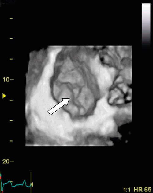 Figure 2  Transthoracic recording of the mitral valve viewed from the left atrium («surgeon’s view»). The white arrowhead…