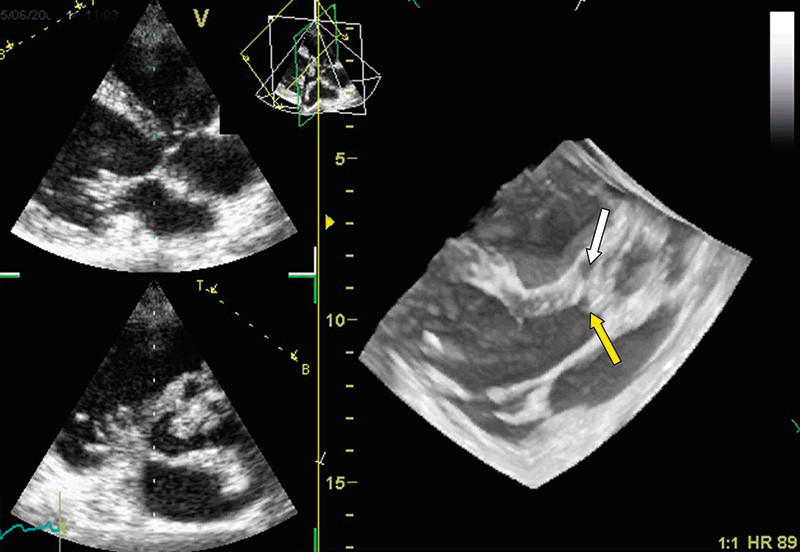 Fig 3  Transthoracic recording in patient with aortic valve endocarditis. The yellow arrowhead marks valvular vegetations…