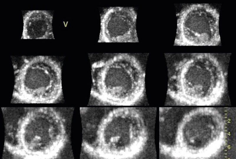 Figure 4  Short-axis sections of left ventricle from full volume recording in a normal, healthy individual. At the top left…