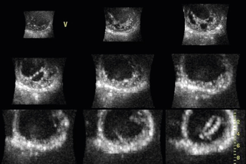 Figure 5  Short-axis section of left ventricle in patient with non-compaction cardiomyopathy. In apical sections «spongy»…