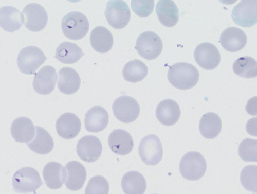 Figure 1 Plasmodium falciparum ring forms in peripheral blood smear from pregnant woman with severe malaria and 14 %…