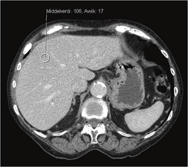 Figure 3  CT abdomen without contrast. The image shows high attenuation in the liver, as with iron accumulation (in contrast…