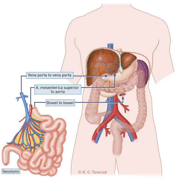 Figure 1   Solated intestinal transplantation with arterial and portal anastomosis in addition to bowel anastomosis and…