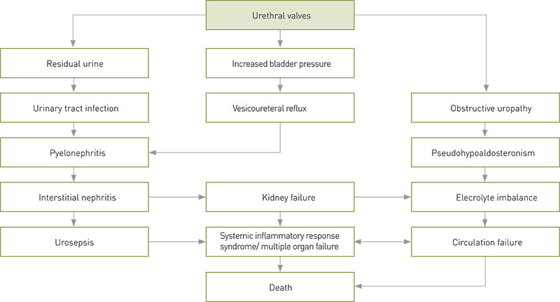 Figure 1  Possible consequences of urethral valves in infants. The figure is based on Paal H.H. Lindenskov’s layout