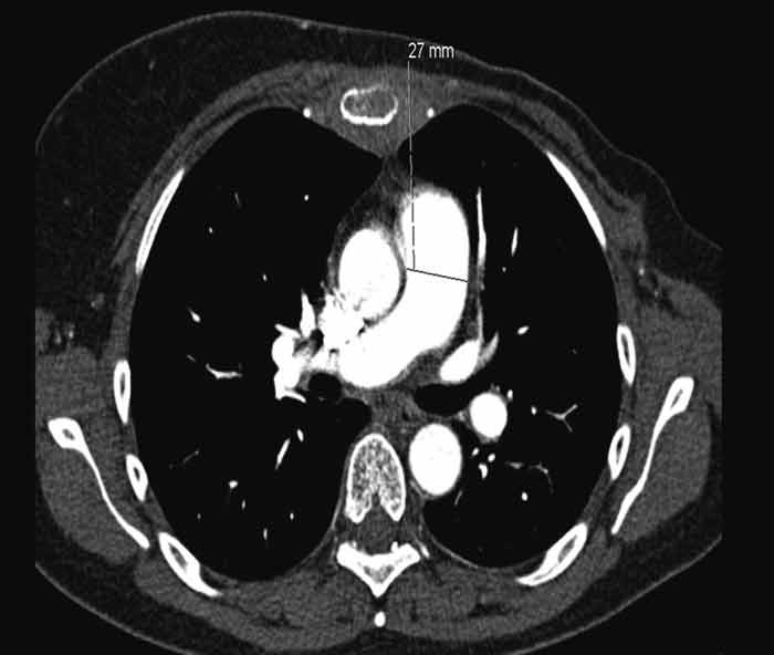 Figure 1  Volume CT thorax with intravenous contrast taken during the first admission to hospital. The truncus pulmonalis…