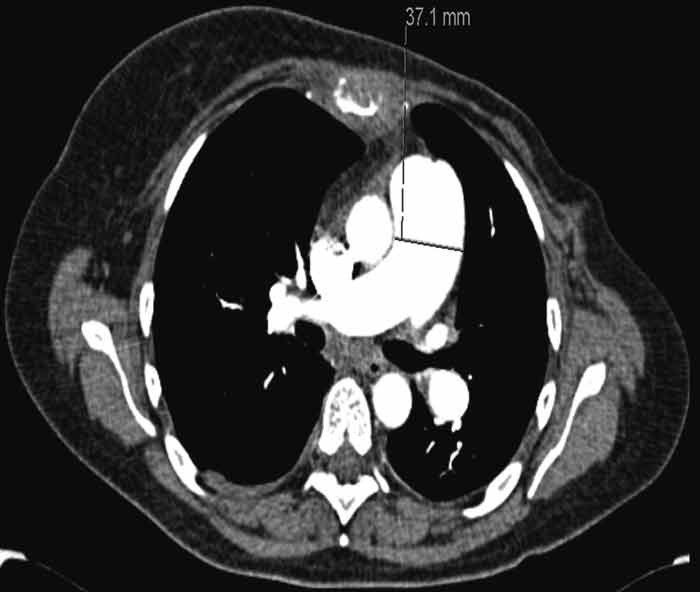 Figure 2  Volume CT thorax with intravenous contrast taken during last hospitalisations shows pronounced truncus pulmonalis…