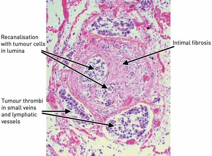 Figure 4  Artery with intimal fibrosis, recanalisation and tumour thrombi in both artery and associated veins/lymph vessels …