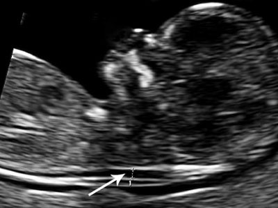 Figure 1:  Ultrasonographic image showing the location for measurement of nuchal translucency (NT) in the fetus. Photo: T. M…