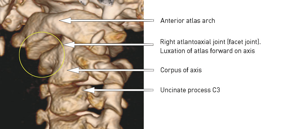 Figure 1  Subluxation of right atlantoaxial joint, viewed from left side/front