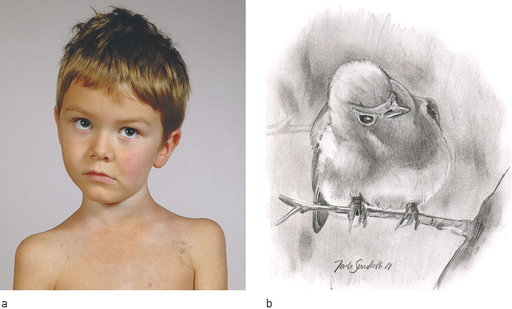 Figure 2  a) «Cock robin» position, thus named because it resembles the head position of a robin listening for a worm (b)…