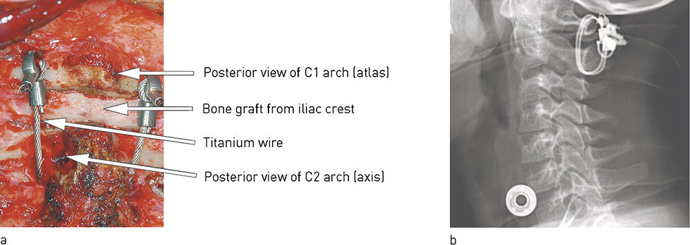 Figure 3  The C1 and C2 arches are fixed to one another with stainless steel or titanium wire bilaterally with a bone graft…