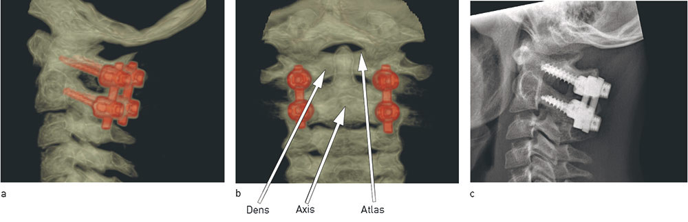 Figure 4  Atlas and axis are fixed with screws and rods bilaterally (Harms technique). CT images from a) the side and b)…