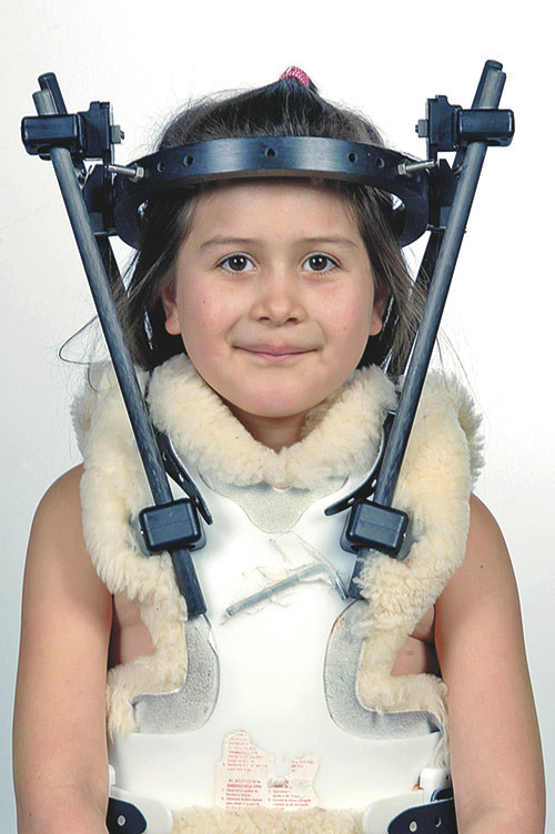 Figure 5  Postoperative external fixation in halo vest. The patient and her parents have given their consent for publication…