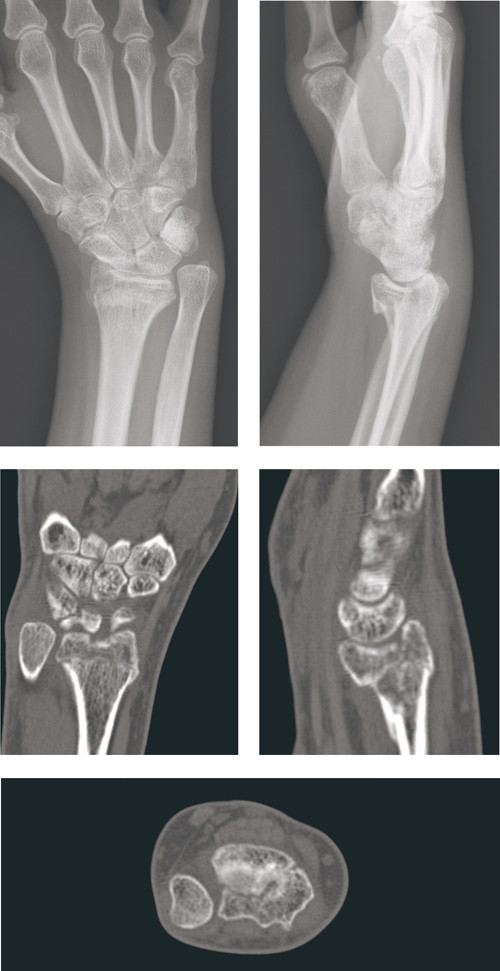 Figure 1 Radiological result after conservative treatment of unstable, intra-articular distal radius fracture in patient in…