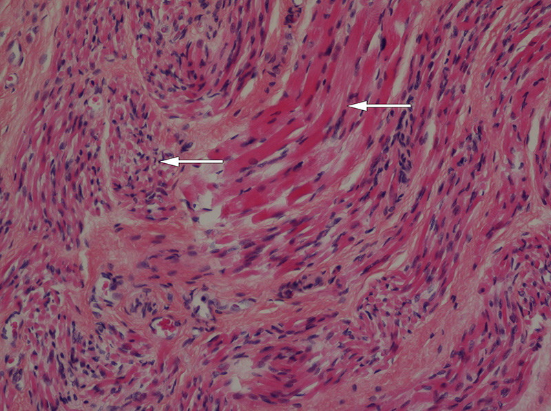 Figure 4  Biopsy from arm muscle showing grouped muscular atrophy with atrophic fibres (arrowhead) surrounding a bundle of…