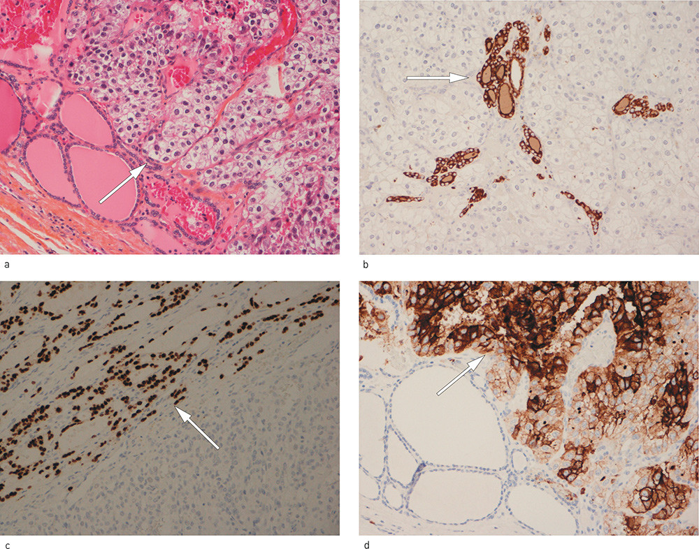 Figure 1  Metastasis from renal cell carcinoma bordered by normal thyroid follicles. a) Hematoxylin-eosin-safran stained…