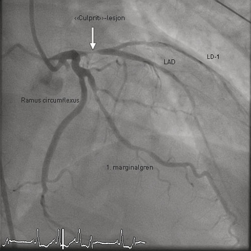 Figure 1  Coronary angiogram showing the left coronary artery. The culprit lesion proximally in the left anterior descending…