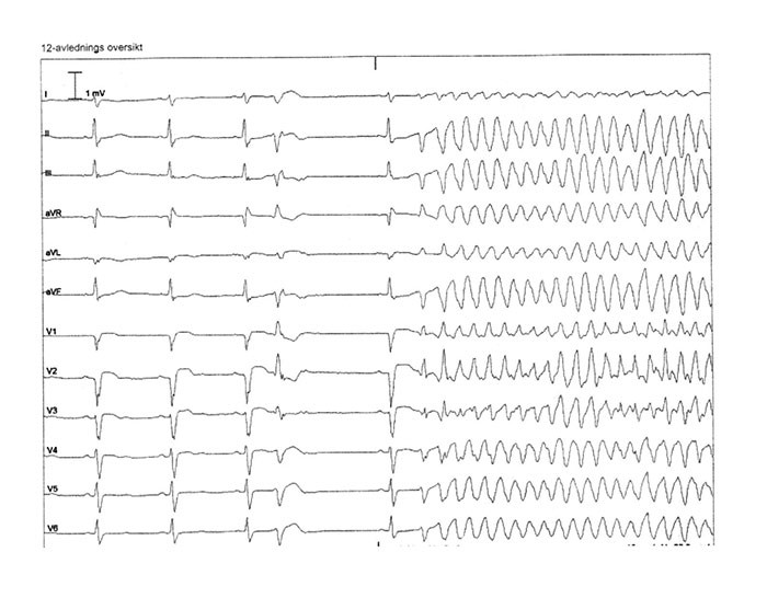 Figure 2  ECG shows two normal beats followed by a ventricular extrasystole with a short coupling interval. After this there…