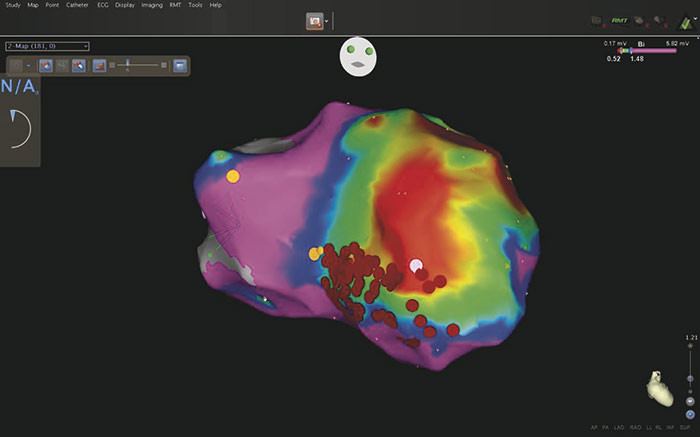 Figure 3  is a three-dimensional electroanatomical model of the left ventricle viewed from the apex. The colours indicate…