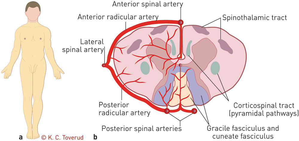 Figure 1  a) The extension of the patient's neurological impairment shown in yellow and b) a section of the spine with blood…