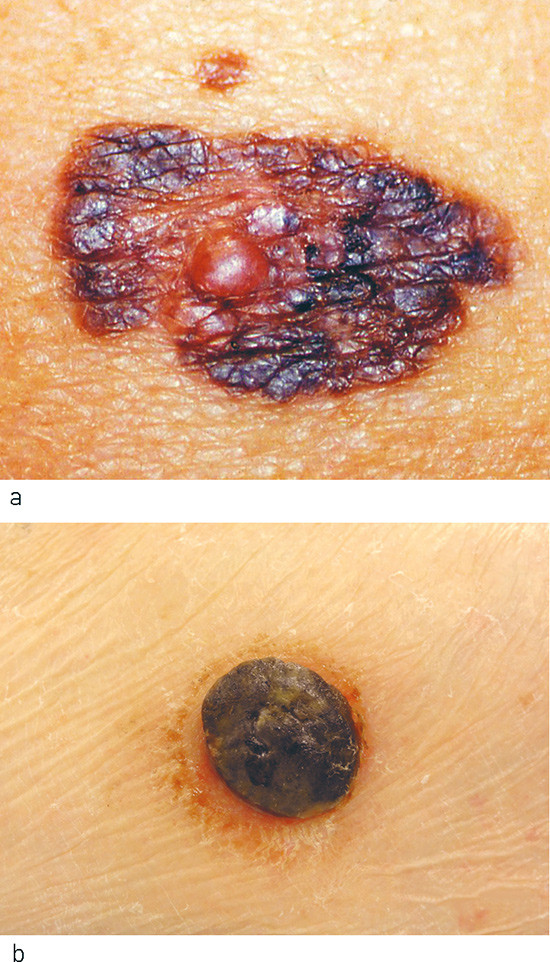 Figure 2  Main types of cutaneous primary malignant melanoma: a) Superficial spreading malignant melanoma and b) nodular…