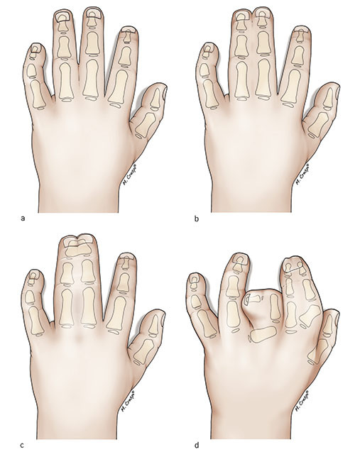 Figure 2  Classification of syndactyly. Syndactyly between long and ring finger. a) Simple incomplete syndactyly b) Simple…