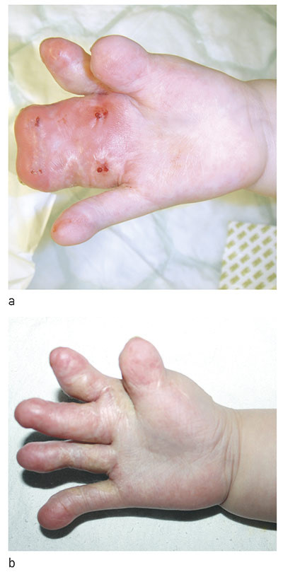 Figure 4  Tissue expansion using external distraction device («magic cube») in a patient with complex syndactyly. Photograph…