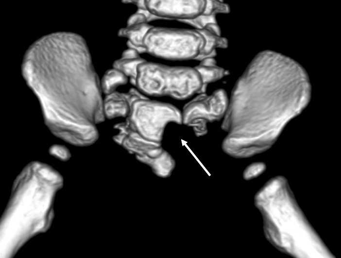 Figure 1  Three-dimensional reconstruction of a volume CT scan showing a marked scimitar defect in the sacral bone,…