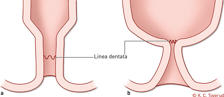 Figure 2  a) Normal anal canal. b) Funnel-shaped anal canal with stenosis at the level of the dentate line – a…
