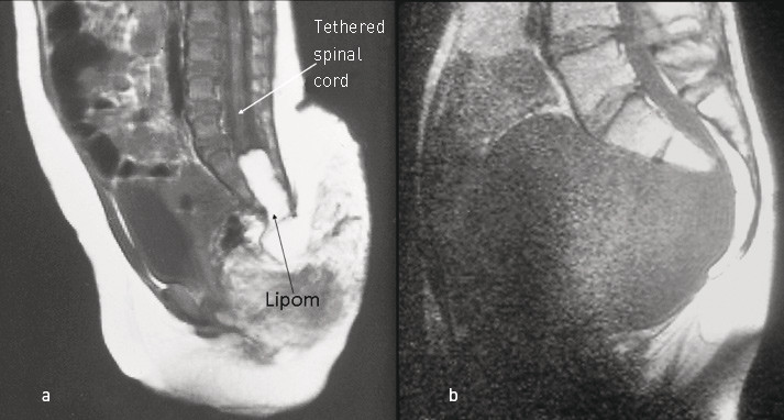 Figure 3  a) Midsagittal MRI showing a tethered spinal cord and intraspinal lipoma. b) Midsagittal MRI showing an anterior…