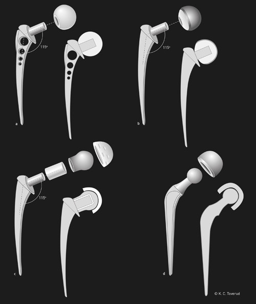 Figure 3  a) Christiansen’s hemiprosthesis as used in the period 1965 – 67. A loose femoral head articulates with a…