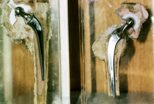 Figure 4  Two samples from autopsies. On the left, a Teflon acetabular cup worn out after some years of use. Note vertical…
