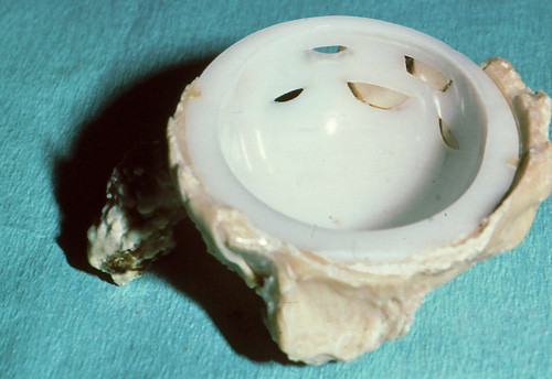 Figure 5  A Christiansen prosthesis revised at the Coastal Hospital in Hagevik. The Delrin cup has been worn right through…
