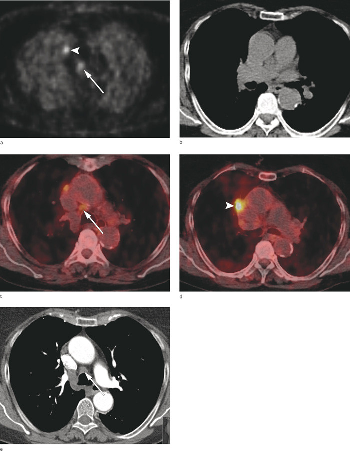 Figure 3a – e Patient with a 2.3 cm squamous cell carcinoma in the right upper lobe close to the mediastinum was examined…