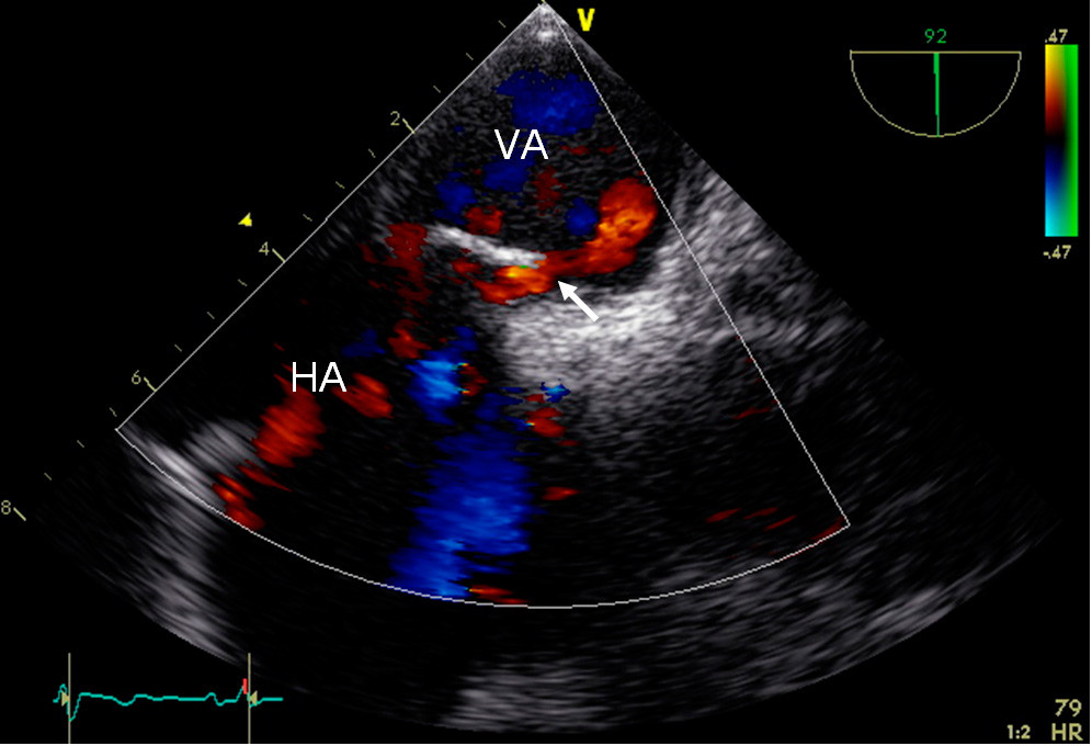 Figure 1  Transoesophageal echocardiogram with saline contrast two days after admission shows right-to-left shunt from right…