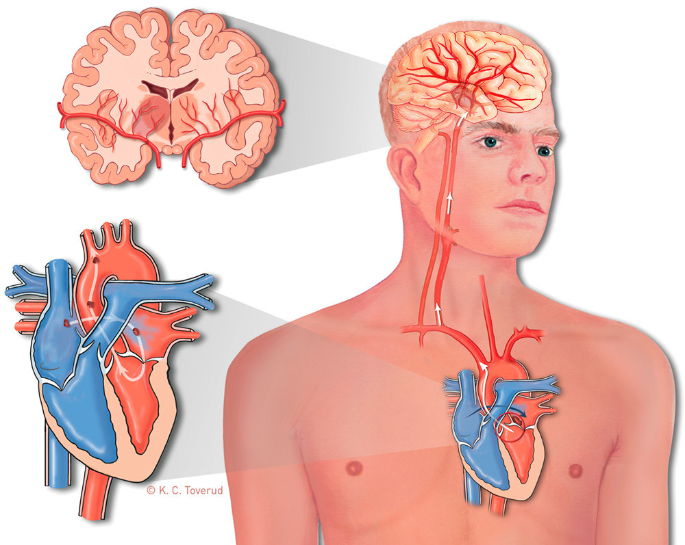 Figure 2  An embolus passes through a patent foramen ovale from the right to the left atrium and embolises to the brain,…
