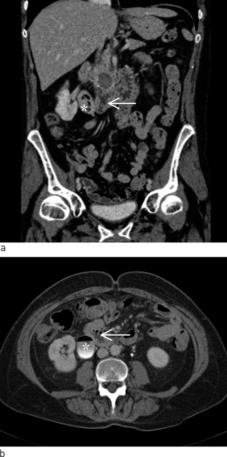 Figure 1  CT urinary tract with intravenous contrast in secretion phase. Coronal (a) and axial (b) reconstruction show close…