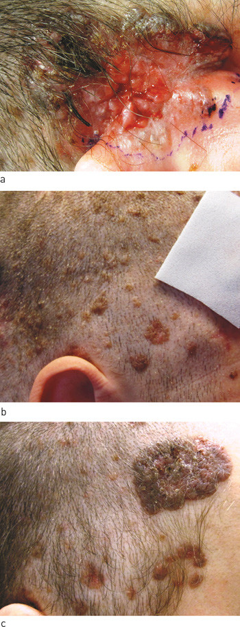 Figure 1  The patient at first visit to the dermatologist. a) Weeping sore in a basal cell carcinoma behind the ear. b)…