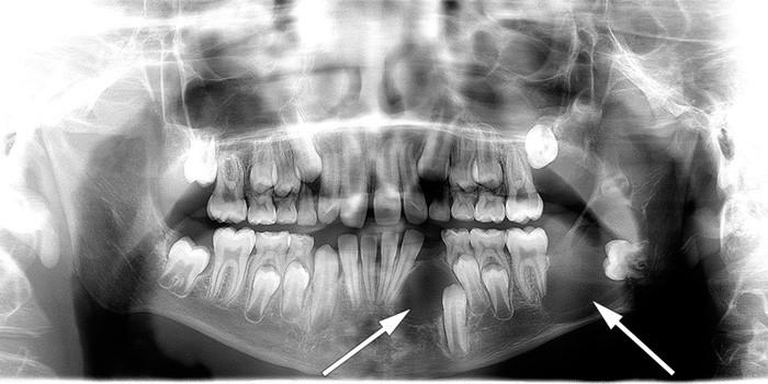 Figure 2  Illustrative image showing jaw cysts. Orthopantomography (OPG) of a boy diagnosed with Gorlin syndrome. In the…