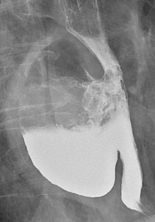 Figure 1 Large, partly contrast-filled epiphrenic oesophageal diverticulum facing towards the right in the mediastinum