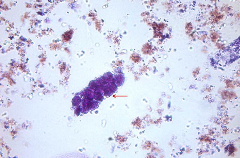 Figur 4  Urinsediment forst&oslash;rret 40 ganger viser en cellesylinder. Disse dannes ved at celler (i dette tilfellet&hellip;