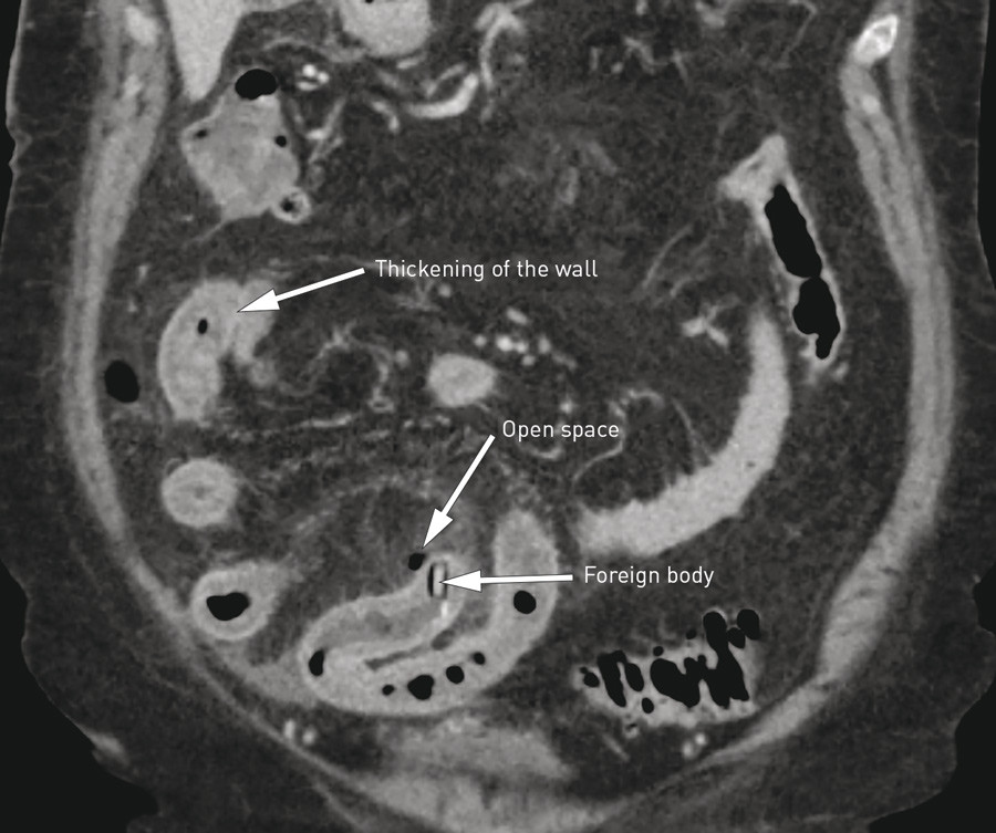 Figure 1  Abdominal CT scan shows perforation of the small intestine by a foreign body (tablet in blister pack) and…
