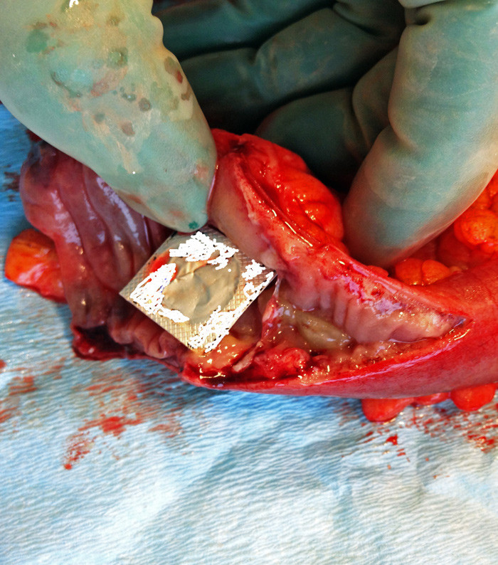 Figure 3  Photo of tablet in blister pack (retouched to avoid identification of the brand) in opened small intestine, with…