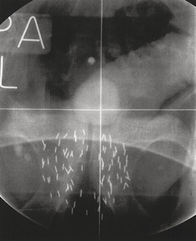 Figure 2  Radiological scan of the pelvis after low-dose-rate brachytherapy. Multiple radioactive iodine seeds are implanted…