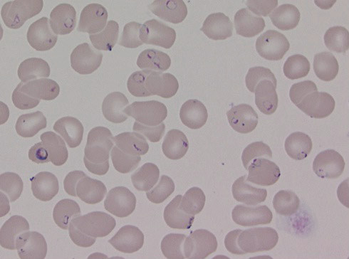 Figure 1  Thin smear showing high parasitaemia in patient with severe falciparum malaria. In such cases, rapid treatment…