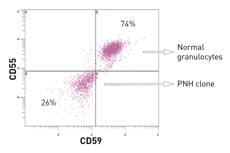 Figure 1 Example of flow cytometric analysis. Granulocytes that express neither CD59 nor CD55 make up the PNH clone, and…