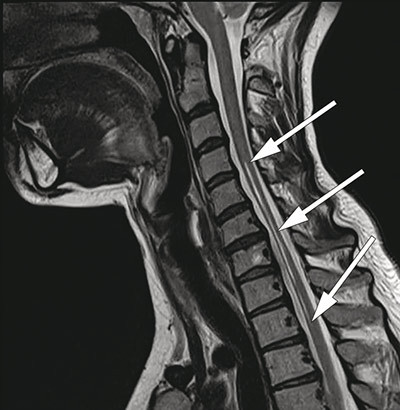 Figure 3  Sagittal T2-weighted cervical MRI with atrophy of the medulla from C6 to Th2 and hyperintense lesion from C4 to Th2