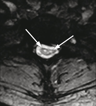 Figure 4  Axial T2-weighted MRI of cervical medulla with symmetrical hyperintense lesions localised to the site of the…